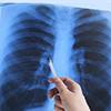 lungs-xray3-respiratory-100x100
