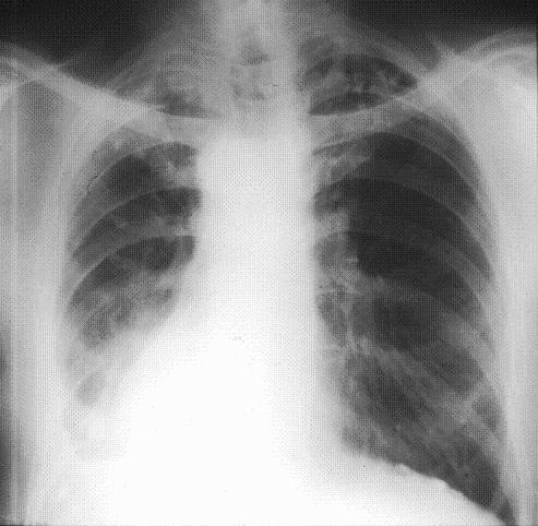 Lungs effected by Asbestos