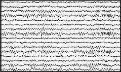 An electroencephalogram (EEG) trace