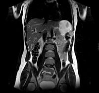 Example of MRI Abdomen scan