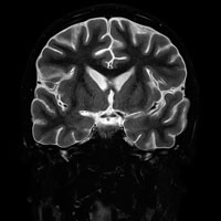 Example of MRI Brain scan