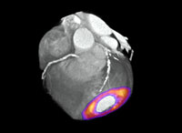 Example of Cardiac PET scan