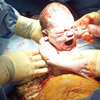 My experience: Caesarean birth