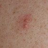 Chicken pox (varicella zoster virus)