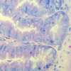 Small bowel cancer (adenocarcinoma of the small intestine)