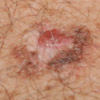 Malignant skin melanoma