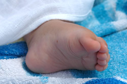 My experience: Clubfoot