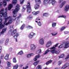 Basal cell carcinoma of the skin