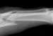 X-ray of a Broken Bone