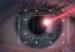 Laser beam on eye