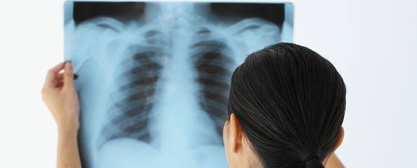 Doctor examining lung x-ray