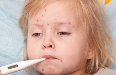 Girl with chicken pox