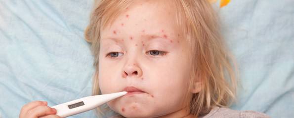 Girl with chicken pox