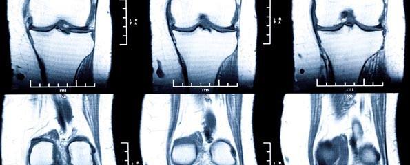 knee MRI - damage of cross and meniscus injury