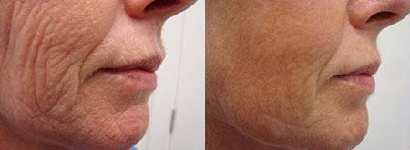 Laser Skin Resurfacing - before and after